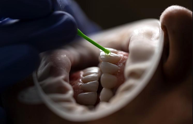 CASO CLÍNICO: CARILLAS DE PORCELANA - Odontologia Global