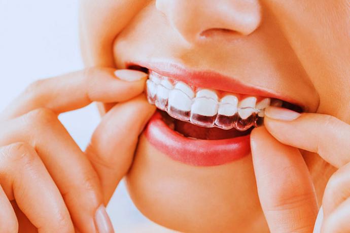 Corrección dental sin sacrificios, conoce las ventajas de la ortodoncia invisible